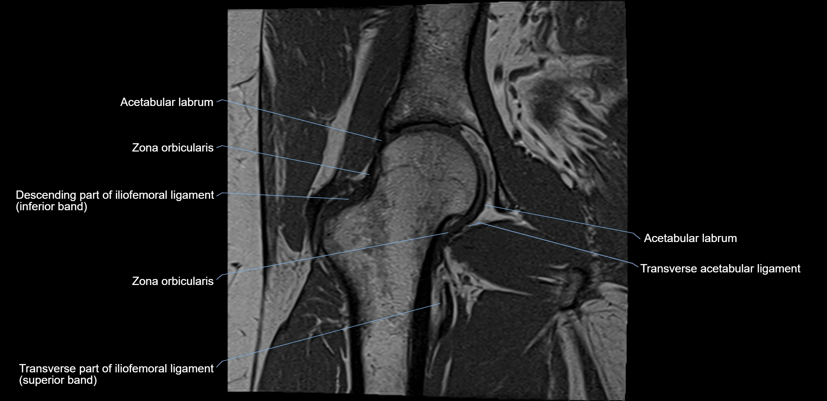 MRI Hip ligaments coronal cross sectional anatomy 3T  radiology  image-img-00001-00013.webp